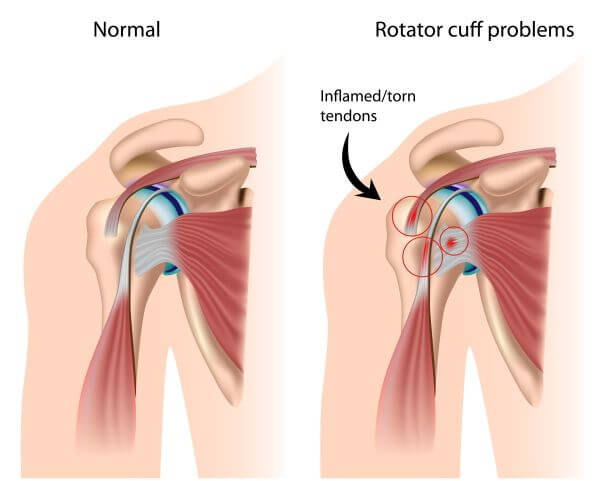 rotator-cuff-injury