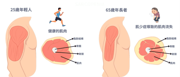老人肌肉流失-老人肌少症-肌少症